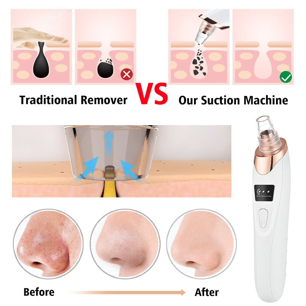 Electric Acne & Blackhead Remover Vacuum